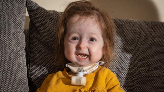 Niña con la "enfermedad de Benjamin Button" tiene una mutación nunca antes vista