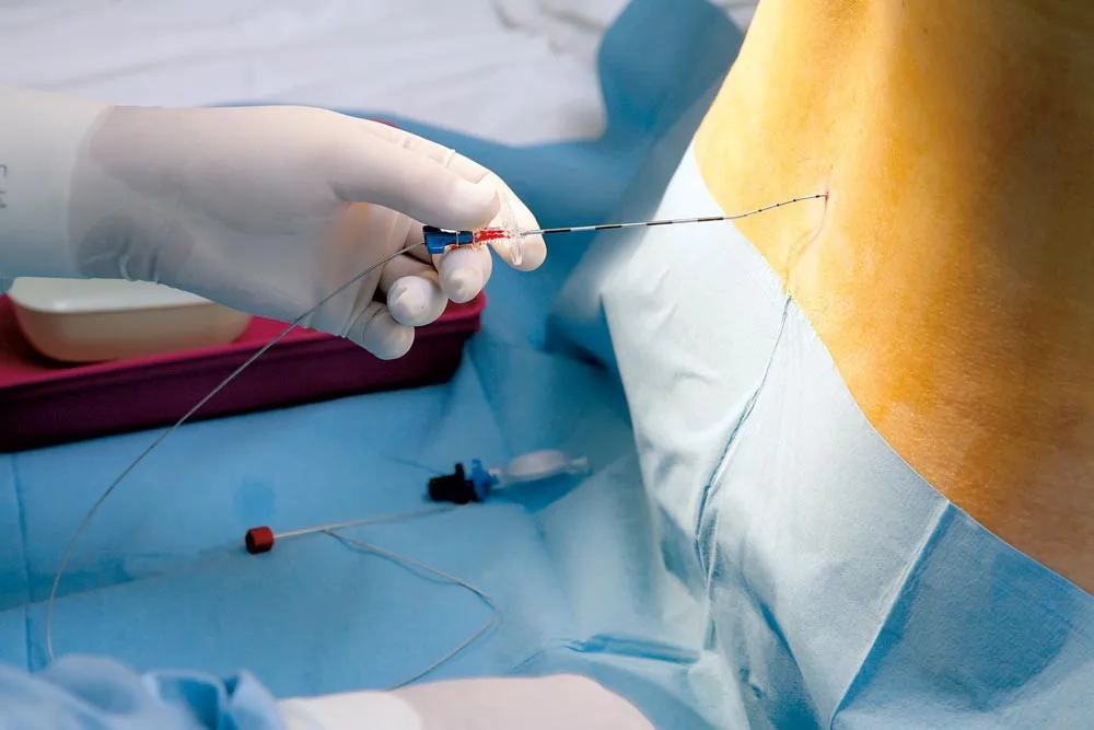 La epidural en el parto no está relacionada con un mayor riesgo de autismo