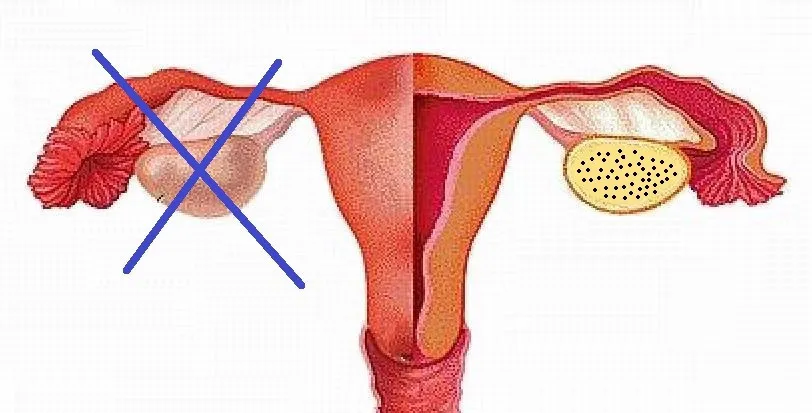 ¿Puedo quedar embarazada después de una histerectomía y con un solo ovario?