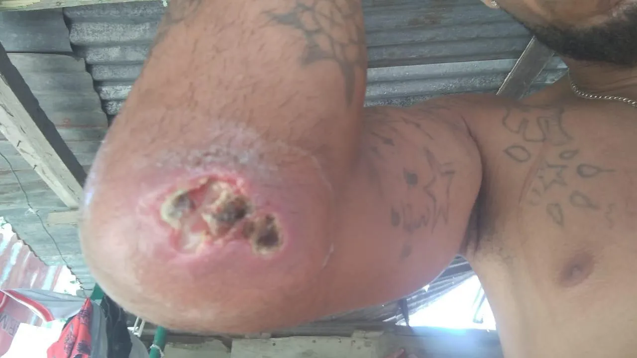 Con el codo prácticamente podrido, joven asegura fue mordido por araña marrón