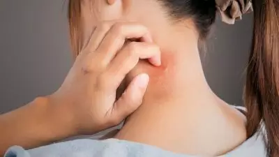 Día Mundial del Lupus: conoce qué es y cuáles son sus síntomas