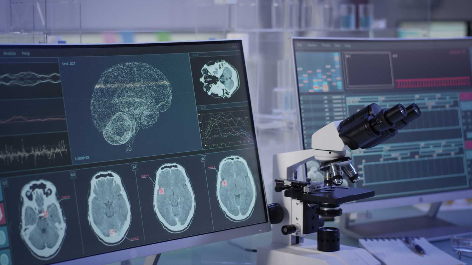 Descubren una proteína implicada en el desarrollo de la esquizofrenia