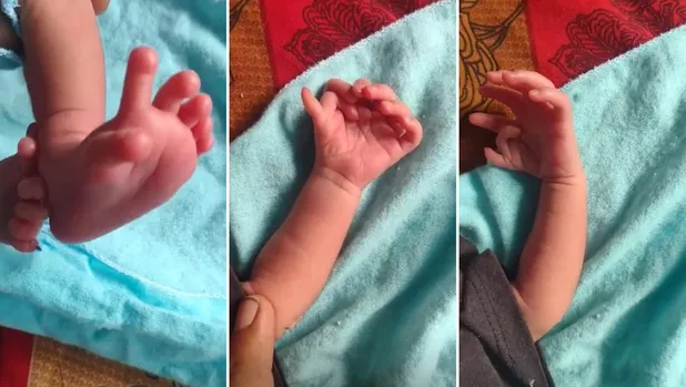 Bebé nace con 26 dedos en India y padres creen que es reencarnación de una deidad