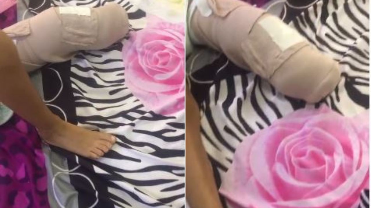 Madre solicita ayuda para prótesis de su hija; perdió pierna tras ser chocada por motorista