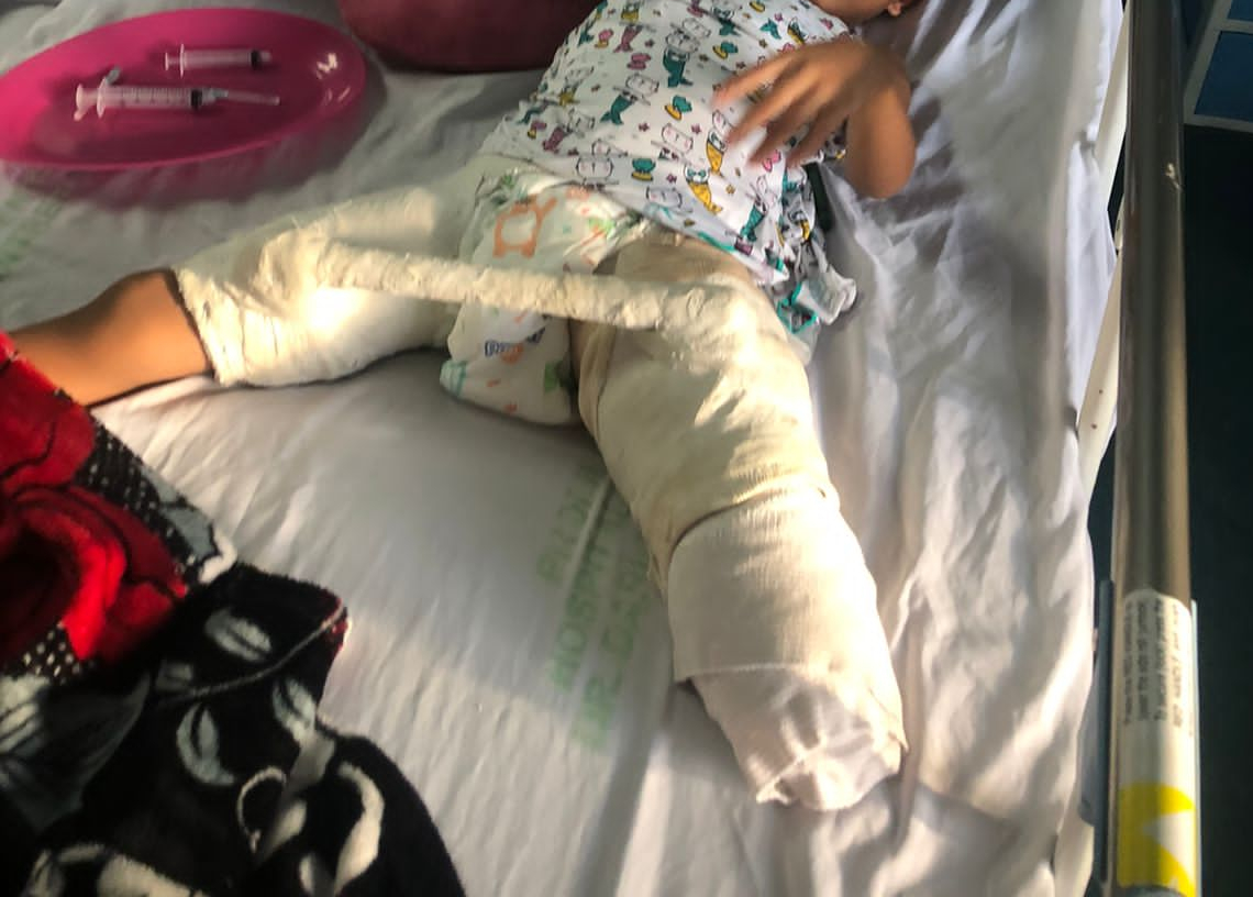 Tras ser amputada de una pierna, una niña adquiere una bacteria en hospital