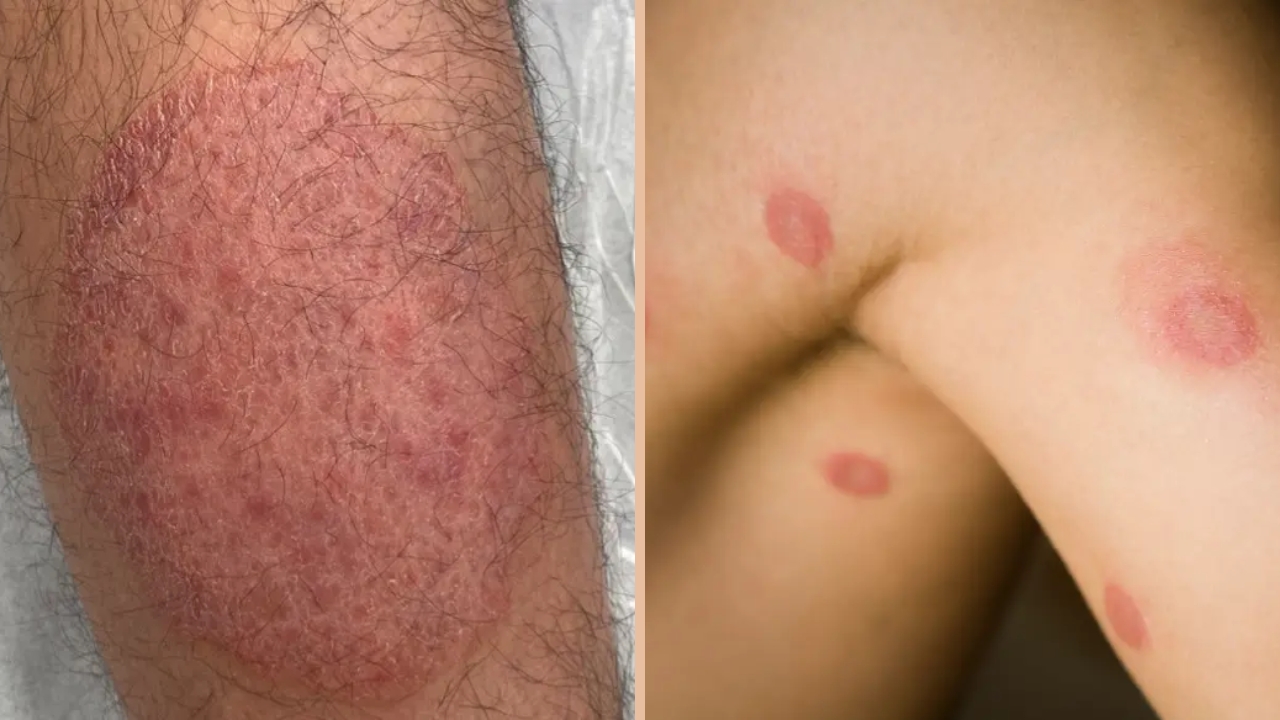 Detectan en Estados Unidos nueva infección fúngica de transmisión sexual 