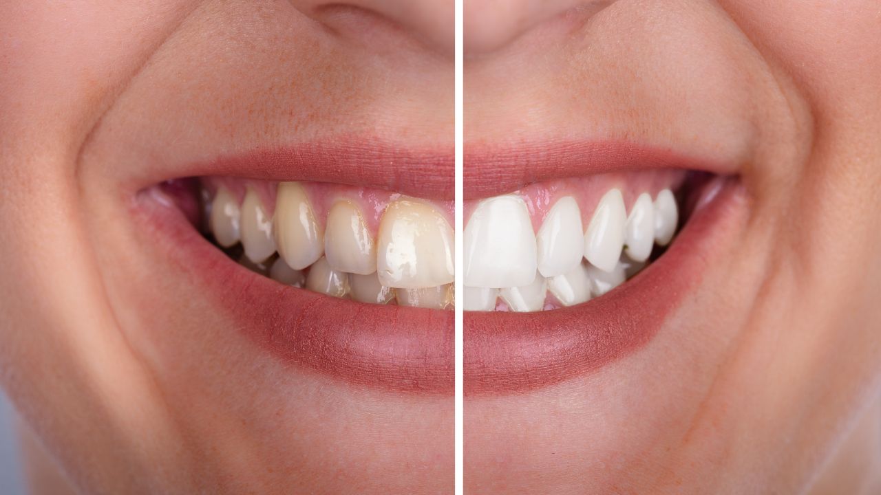 ¿Qué bebida o alimento mancha más los dientes?