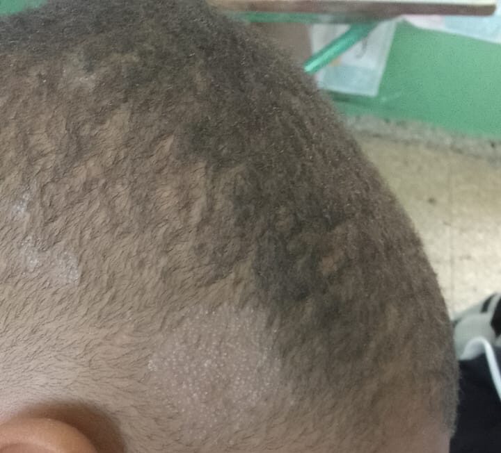 ¡Piojos y hongos! Brote afecta escuela en Santiago y desata preocupación