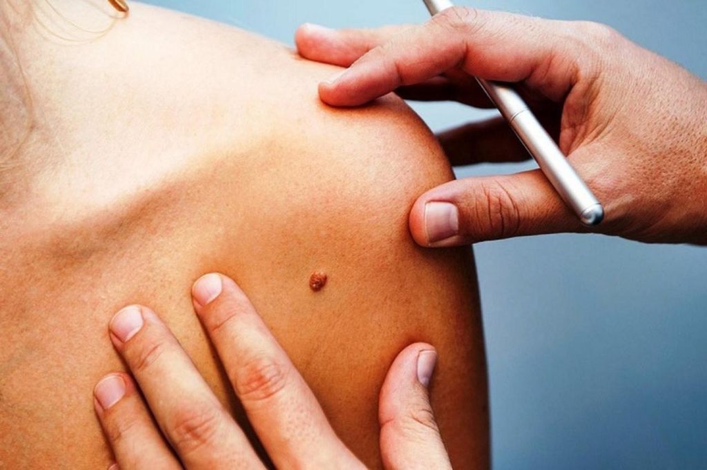 VPH una de las infecciones de transmisión sexual más comunes