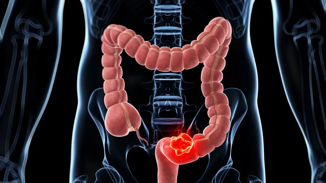 Asocian aumento del cáncer de colon en jóvenes con una infección bacteriana en la infancia