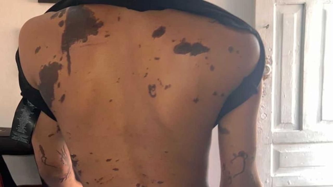 Atacan con "ácido del diablo" a madre e hija en Capotillo
