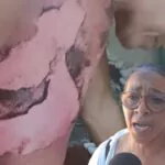 Profesora denuncia fue quemada con agua caliente por una abogada y teme por su vida