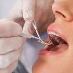 La cirugía oral: clave para recuperar la confianza en la sonrisa y proteger la salud bucal