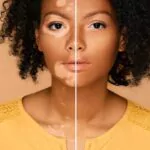 El vitiligo no es contagioso, especialistas llaman a erradicar mitos sobre esta condición de la piel
